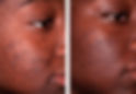 Thumbnail: Tazarotene Cream Zorante 0.1% X 10 Packs