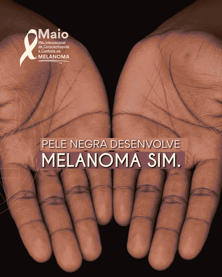 Melanomas e pele negra.