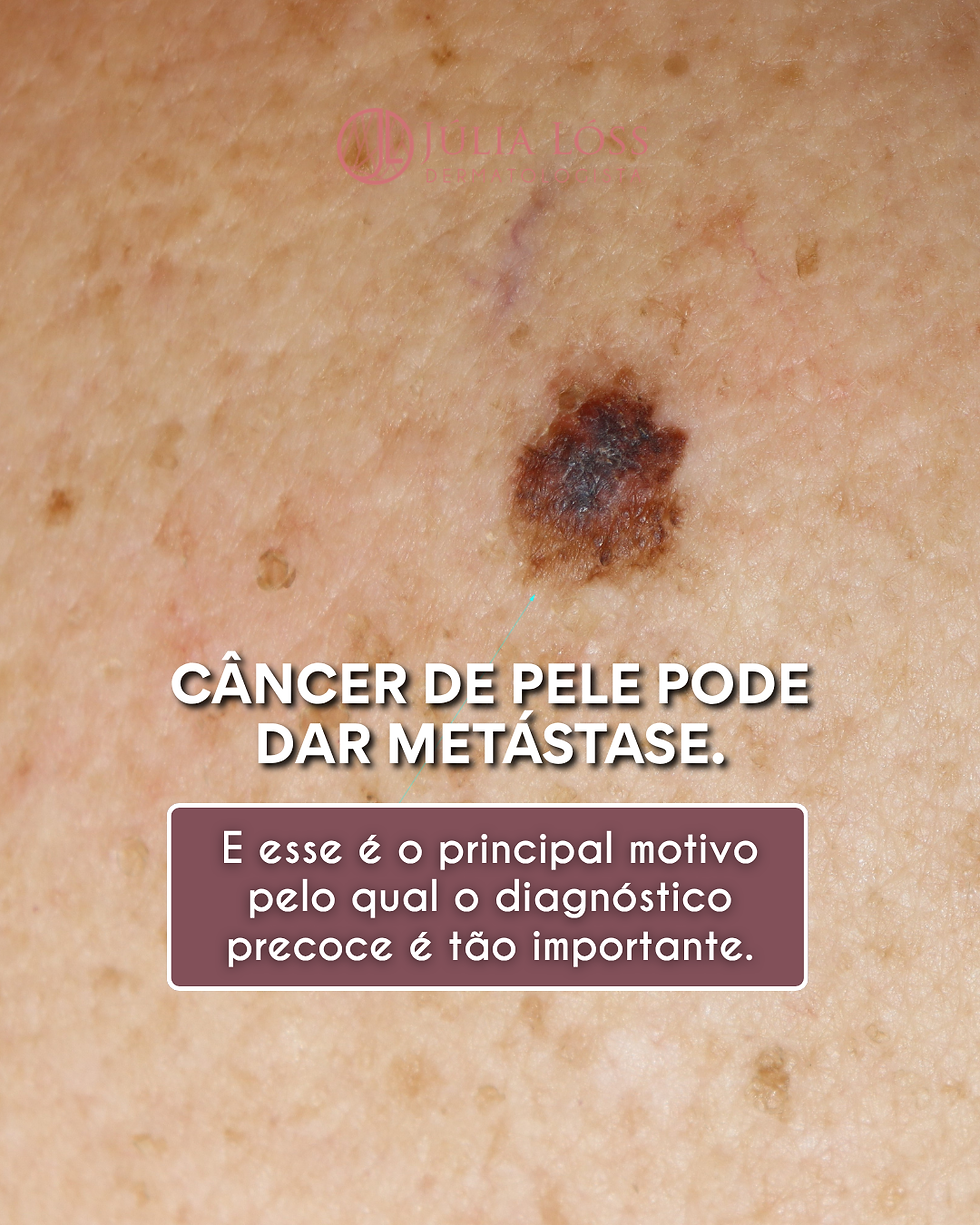 O Câncer de pele Pode dar Metástase.