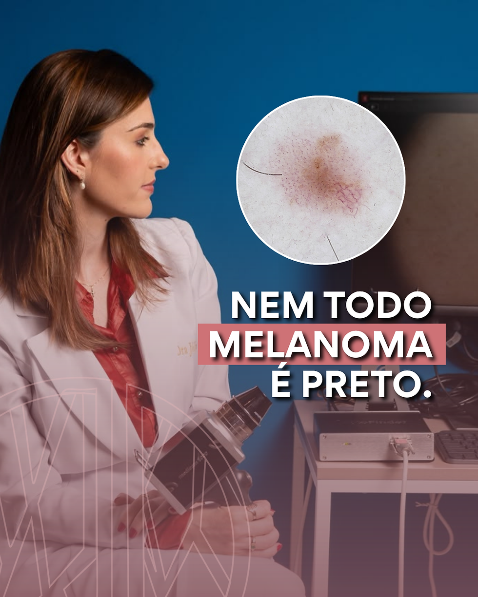 Nem todo melanoma é preto