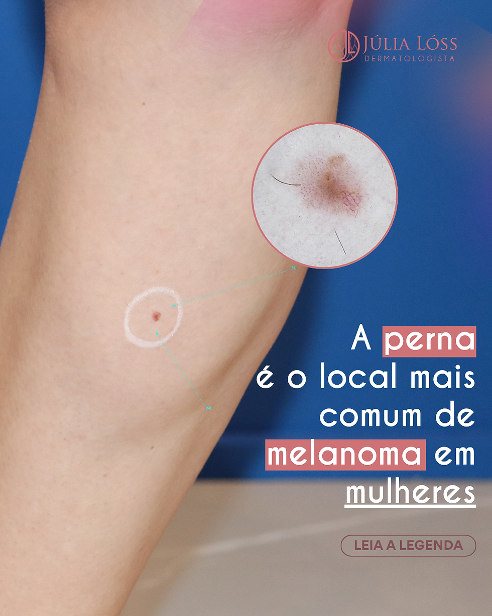 A Perna é o Local mais Comum de Melanoma em Mulheres