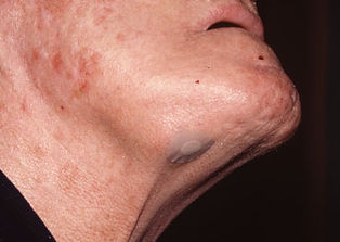 Submandibular tumour