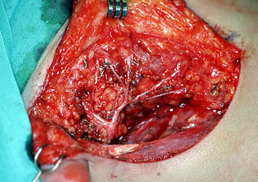 Parotidectomy in progress