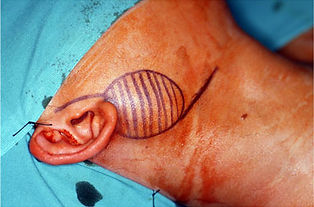 parotid gland tumour
