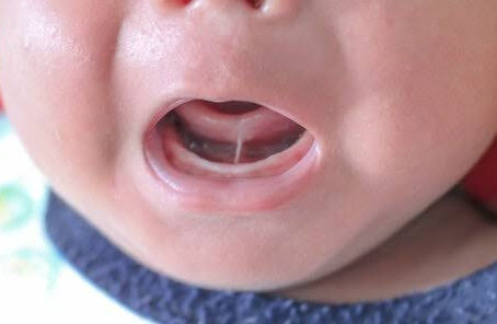 Freio de língua, teste da linguinha e amamentação