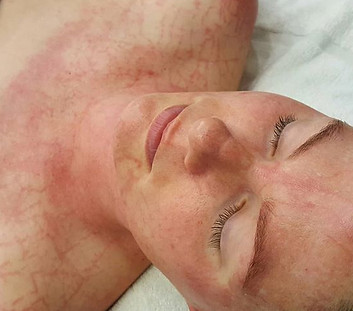 acne, enzyme masque, dmk paris, dmk france, anti age paris, melanotech dmk treatment, dmk paris, dmk traitement paris, dmk france, enzyme masque paris, anti age paris dmk paris, effet plasmatique paris, peeling paris, microneedling paris, enzyme paris, radiofrequence paris, hydra facial paris, beauty derm, bbglow, revitosin, alkaline wash paris hifu paris