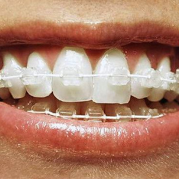 Teeth with braces on smiling