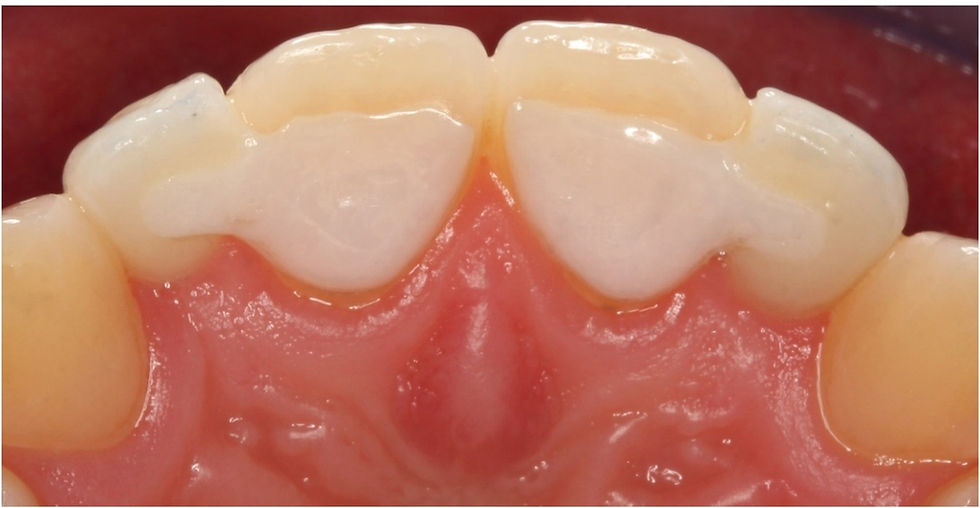 All Ceramic Bonded Bridges – An alternative to Dental Implants