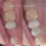 Implante Dental Individual