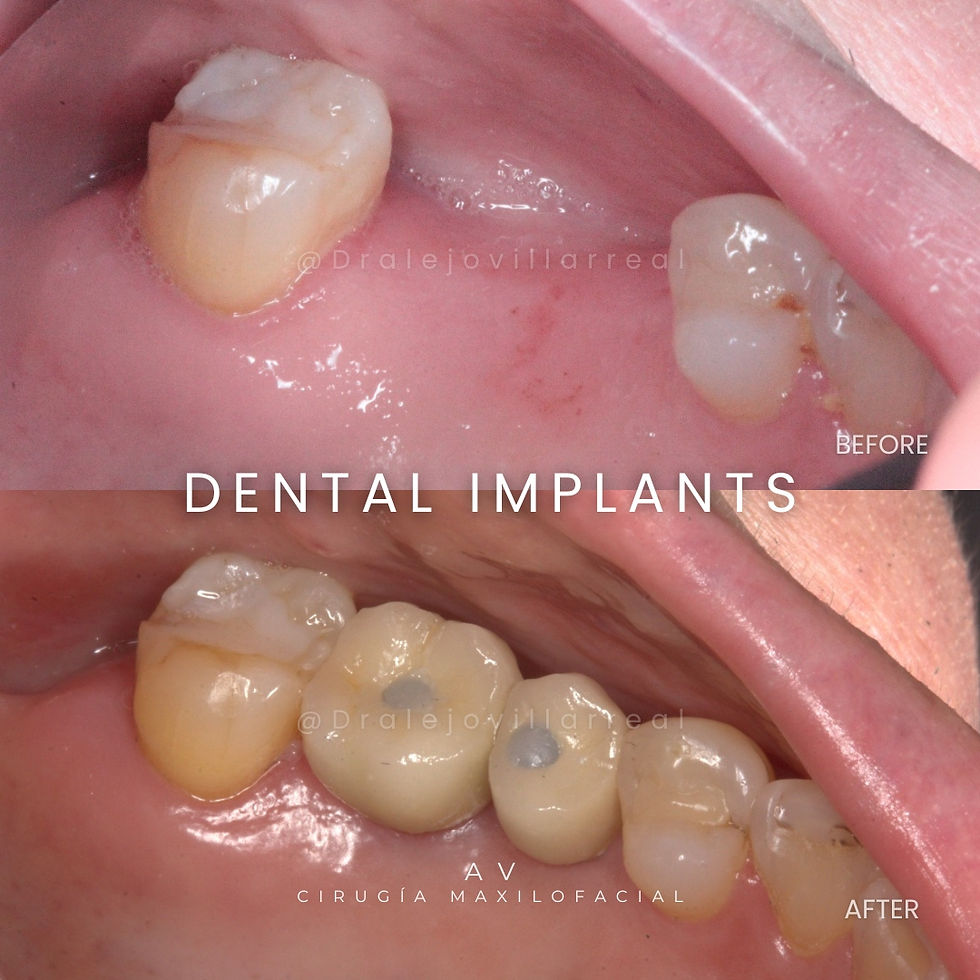 Implantes dentales