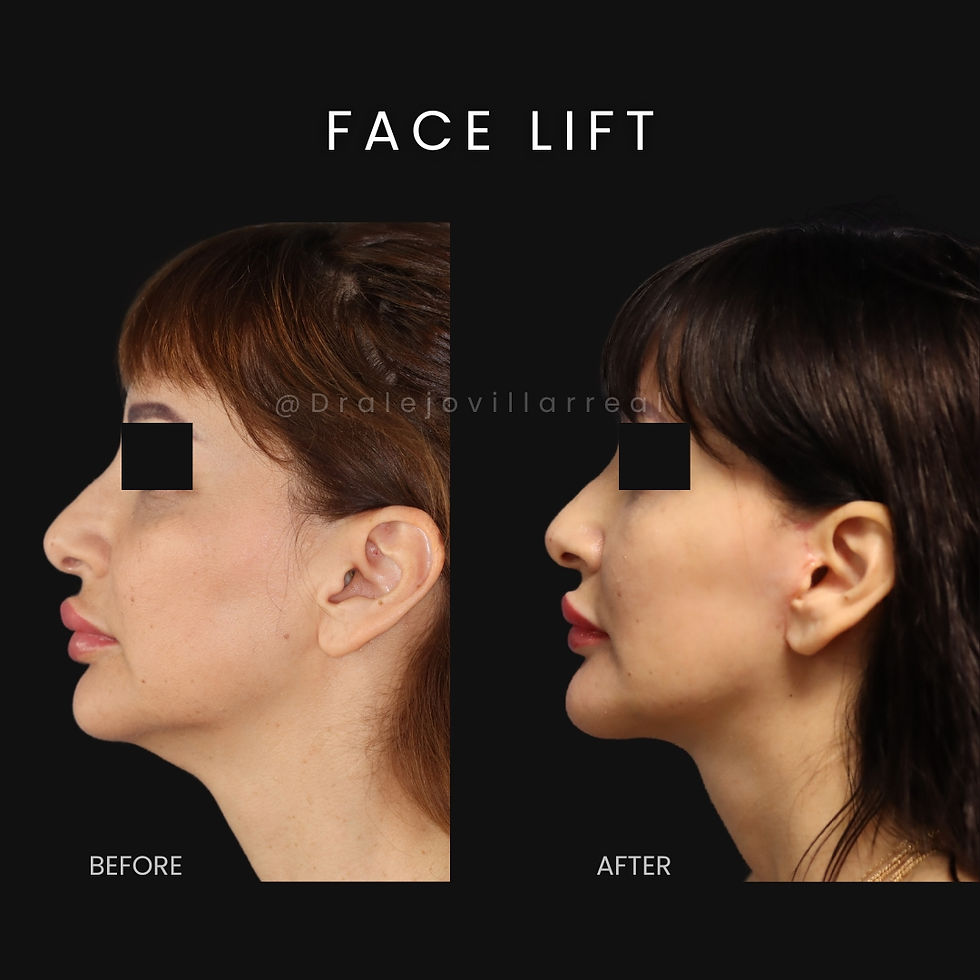 Face Lift