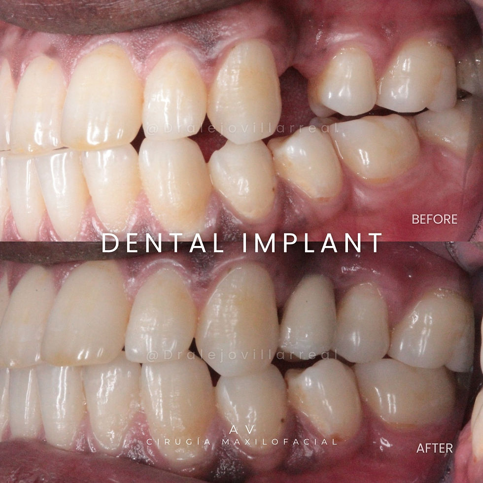 Implante Dental Individual