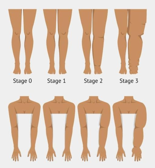 L'évolution du lipoedème
