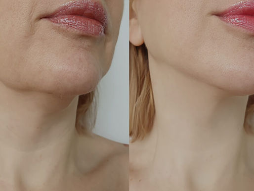 Discover the Amazing Laser Resurfacing Benefits for Your Skin