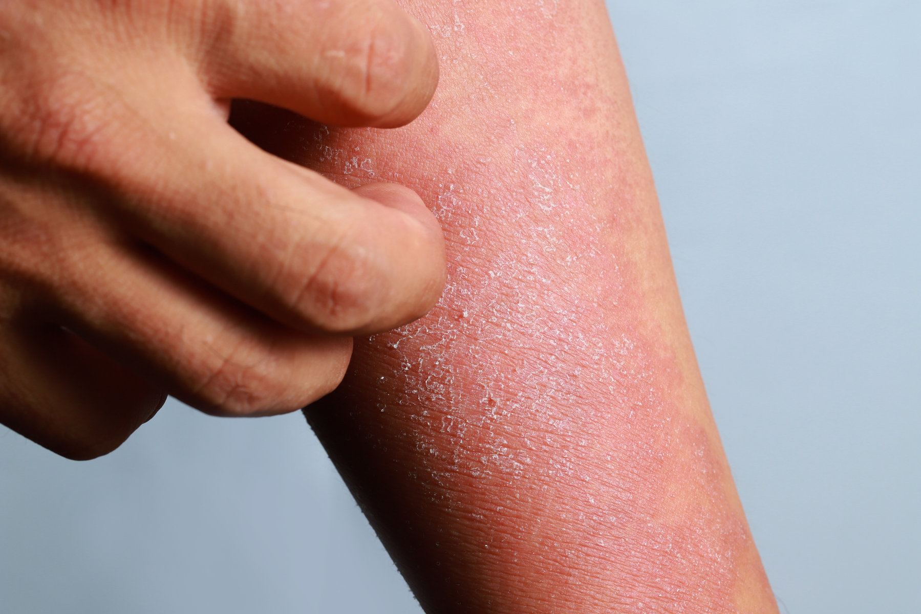Eczema: What Is It, How To Treat It, And What You Can Do To Prevent It
