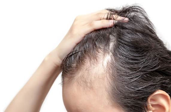 Stress Awareness Month: Hair Loss Trends and Solutions Explored by Estenove