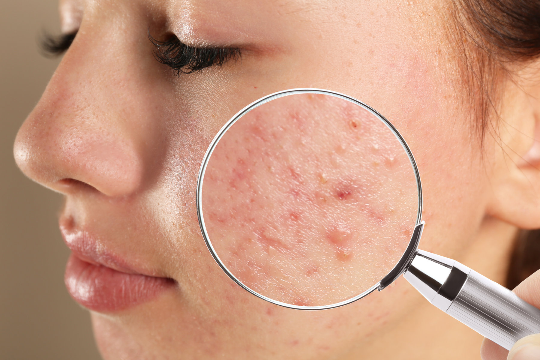 Helpful Tips For Coping With Adult Acne