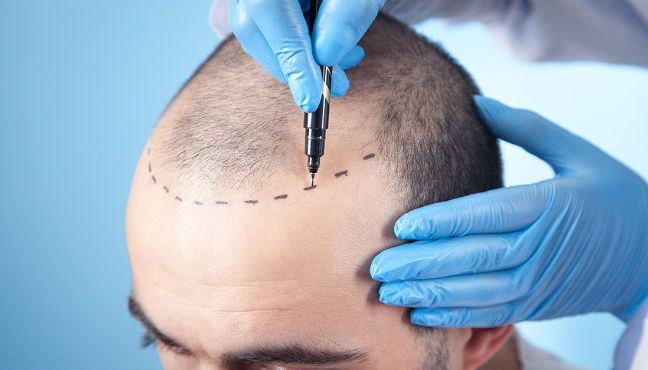 New Year, New Hair… Estenove Shares Expert Tips for Speeding Up Post-Hair Transplant Recovery