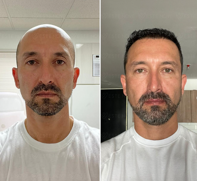 EsteNove complete 2023 by revolutionising hair replacement treatment with 20% female patient increase and cele