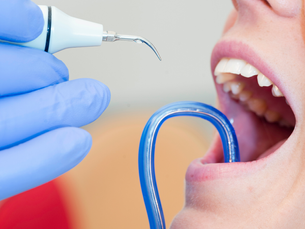 Diş Taşı Temizliği: Sağlıklı Dişler İçin İpuçları Nilüfer diş hekimi