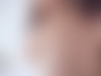 2024թ հունվար-հոկտեմբերին Հայաստանում կարմրուկի 556 դեպք է գրանցվել