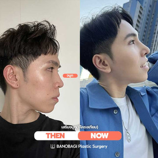 เสริมจมูก สไตล์เกาหลี