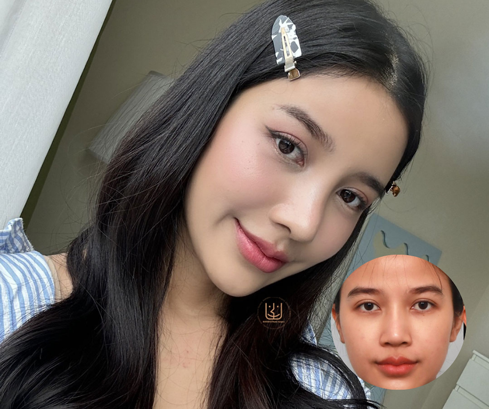 รีวิว ศัลยกรรมจมูก