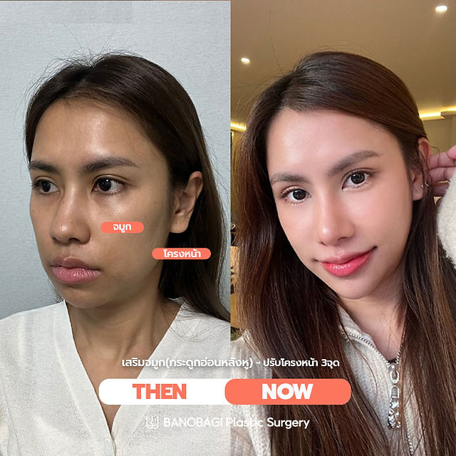 เสริมจมูก สไตล์เกาหลี