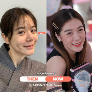 เสริมจมูก สไตล์เกาหลี