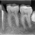 Periapical