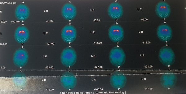 Datscan Parkinson giovanile