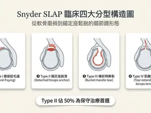 【肩膀深處痛·SLAP自救 Ep.2】肩膀痛是發炎還是軟骨撕裂？物理治療師教你 SLAP 自我檢測 3 招，看懂骨科報告分型