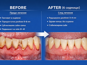 before/after pation with parodontal desies