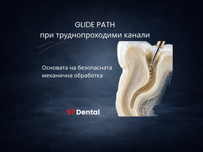 Glide path при труднопроходим коренов канал с ендодонтски инструмент