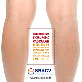 Varizes - clinica vascular Takahama - tatuapé