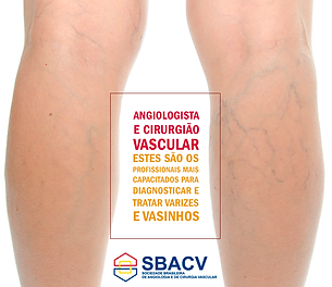 Varizes - clinica vascular Takahama - tatuapé