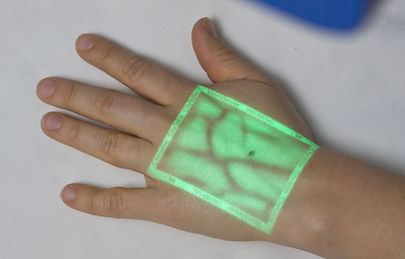 VeinViewer-Technology-for-Patients-with-