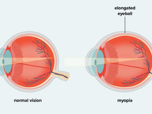 An Australian Optometrist’s Perspective on Choosing Myopia Treatment