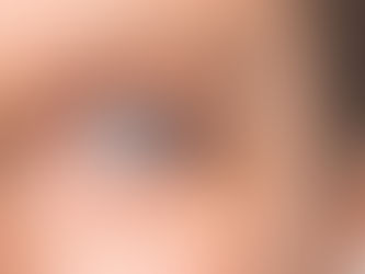 Cataracts: A Long Term Effect of High Myopia    