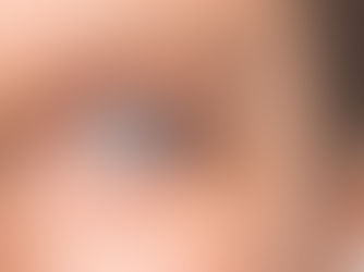 Cataracts: A Long Term Effect of High Myopia