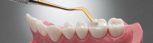 dental_composite_filling_tourmedical_dentist_kusadasi_edited_edited.jpg