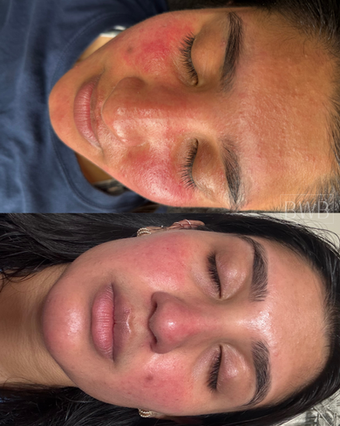 rosacea, skincare, facial, skin treatment, redness, inflamed skin, skin itching, skincare, circadia, sensitive skin, reducing rosacea, facial treatment for rosacea, skin health, calming skin, calming rosacea, acne, fungal acne