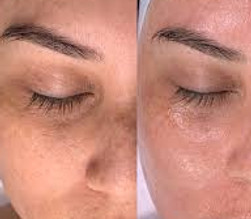 before and after hydrafacial