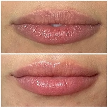 before and after hydrafacial