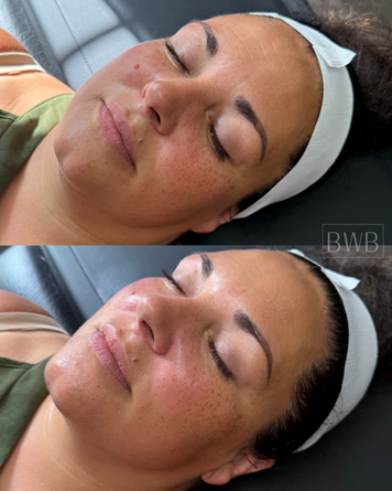 hydrafacial before and after