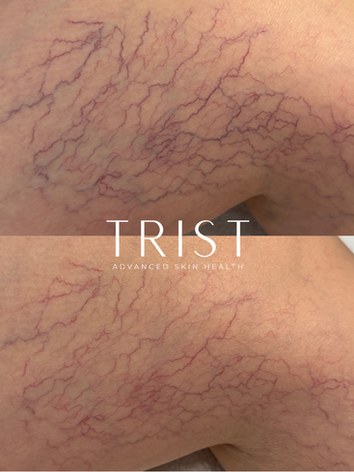 spider vein treatment before and after