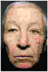 skin aging uv damage