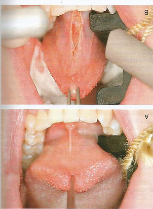 Lingual Frenectomy0004.jpg