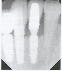 Periimplantitis Bone.jpg
