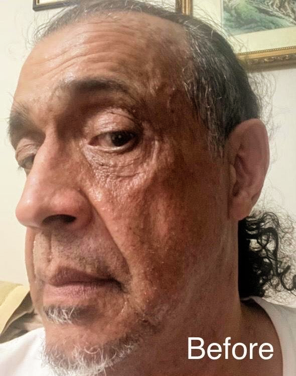 Before skincare treatment photo showing visible fine lines